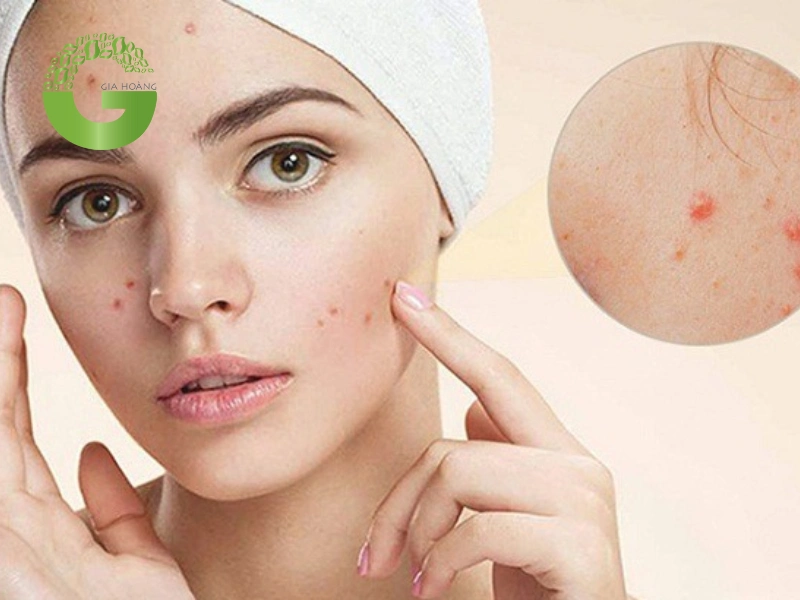 Trị vết côn trùng cắn và mụn trứng cá bằng than hoạt tính