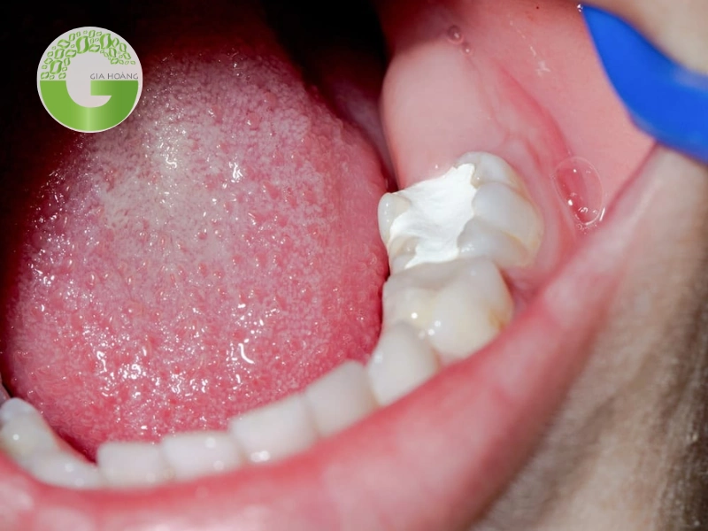 ứng dụng của Ca(OH)2 trong nha khoa