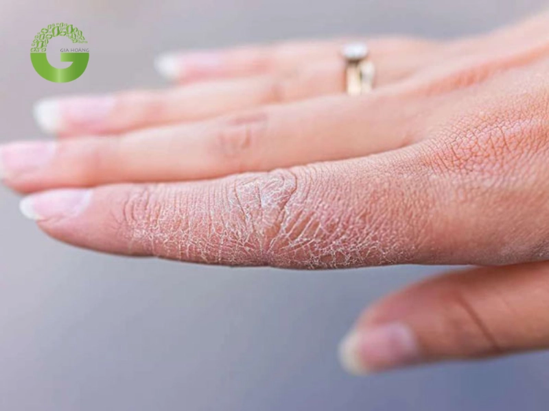 Vôi tôi có thể gây tình trạng khô da nếu tiếp xúc lâu